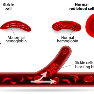 First new treatment for sickle cell in 20 years