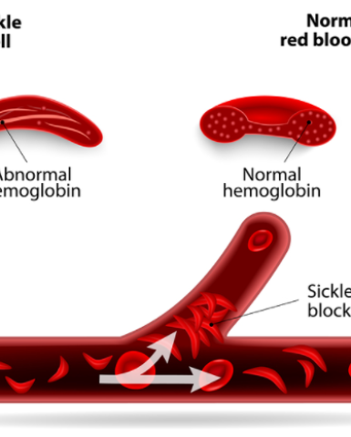 First new treatment for sickle cell in 20 years