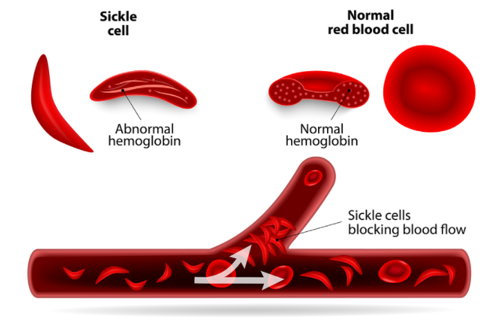 First new treatment for sickle cell in 20 years