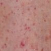 Red Dots on Skin: The Link Between Leukemia and Petechiae
