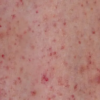 Red Dots on Skin: The Link Between Leukemia and Petechiae