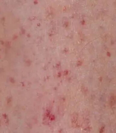 Red Dots on Skin: The Link Between Leukemia and Petechiae
