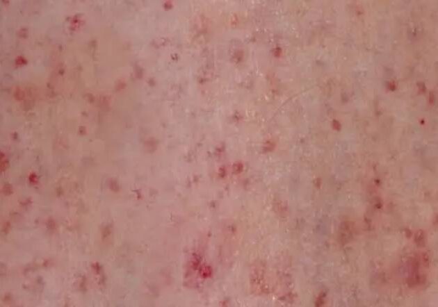 Red Dots on Skin: The Link Between Leukemia and Petechiae