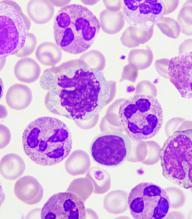 New research aims to transform treatments of aggressive blood cancer