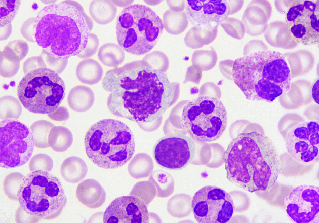 New research aims to transform treatments of aggressive blood cancer